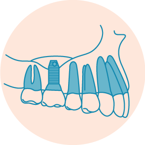 01 Graft Material and Implant Placed MintoBoneGraftingIcons 011322