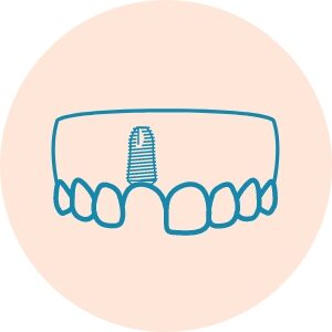 Implant Placement Implant Placed icon