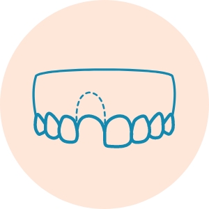 Implant Placement Tooth Loss Icons