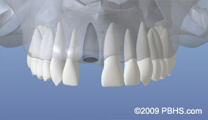 dentalimplant_02