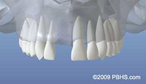 dentalimplant_03