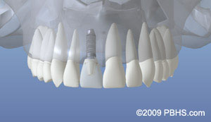 dentalimplant_06