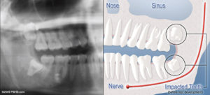 diagram-of-x-ray-and-impacted-wisdom-teeth