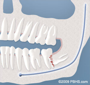 wisdom-tooth-damaging-other-tooth